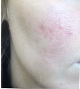 Before using Magic Skin Repair — Heather E.